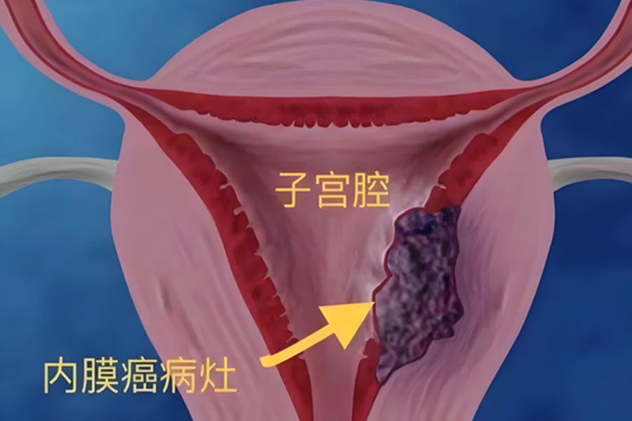27岁确诊子宫内膜癌,“抗癌妈妈”如何保住子宫诞下龙凤胎?探访癌症保育治疗的真相与希望