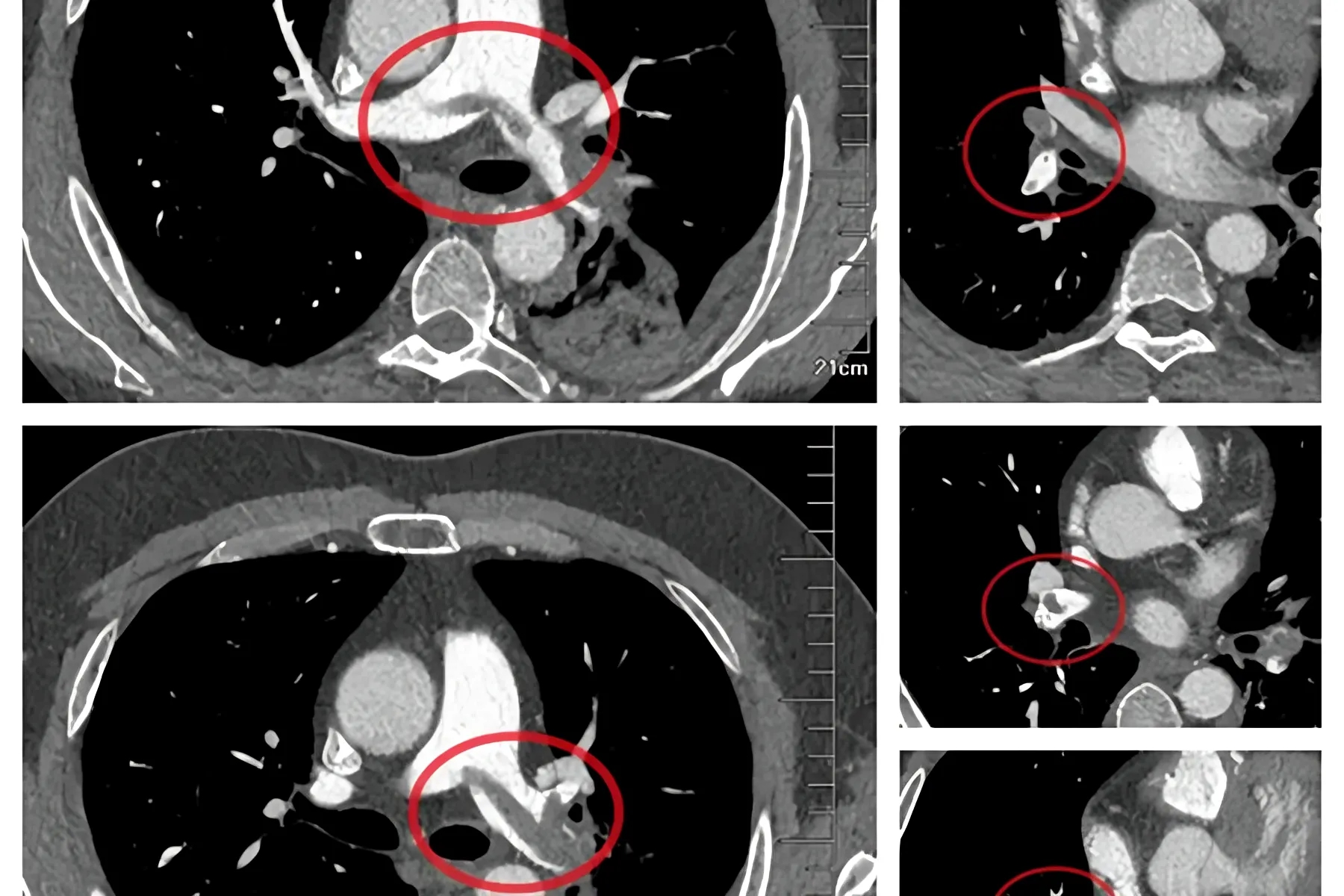 小伙因“感冒”就医,医生敏锐识破致命肺栓塞!精准介入取栓碎栓,成功化解“夺命危机”
